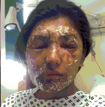 لندن؛ پایتخت جدید اسیدپاشی جهان لندن؛ پایتخت جدید اسیدپاشی جهان