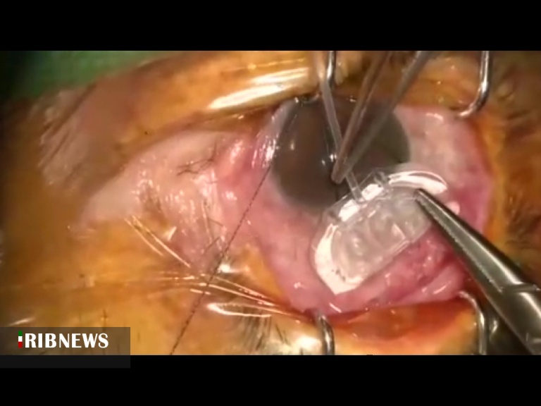 درمان آب سیاه چشم با روش‌های نوین جراحی