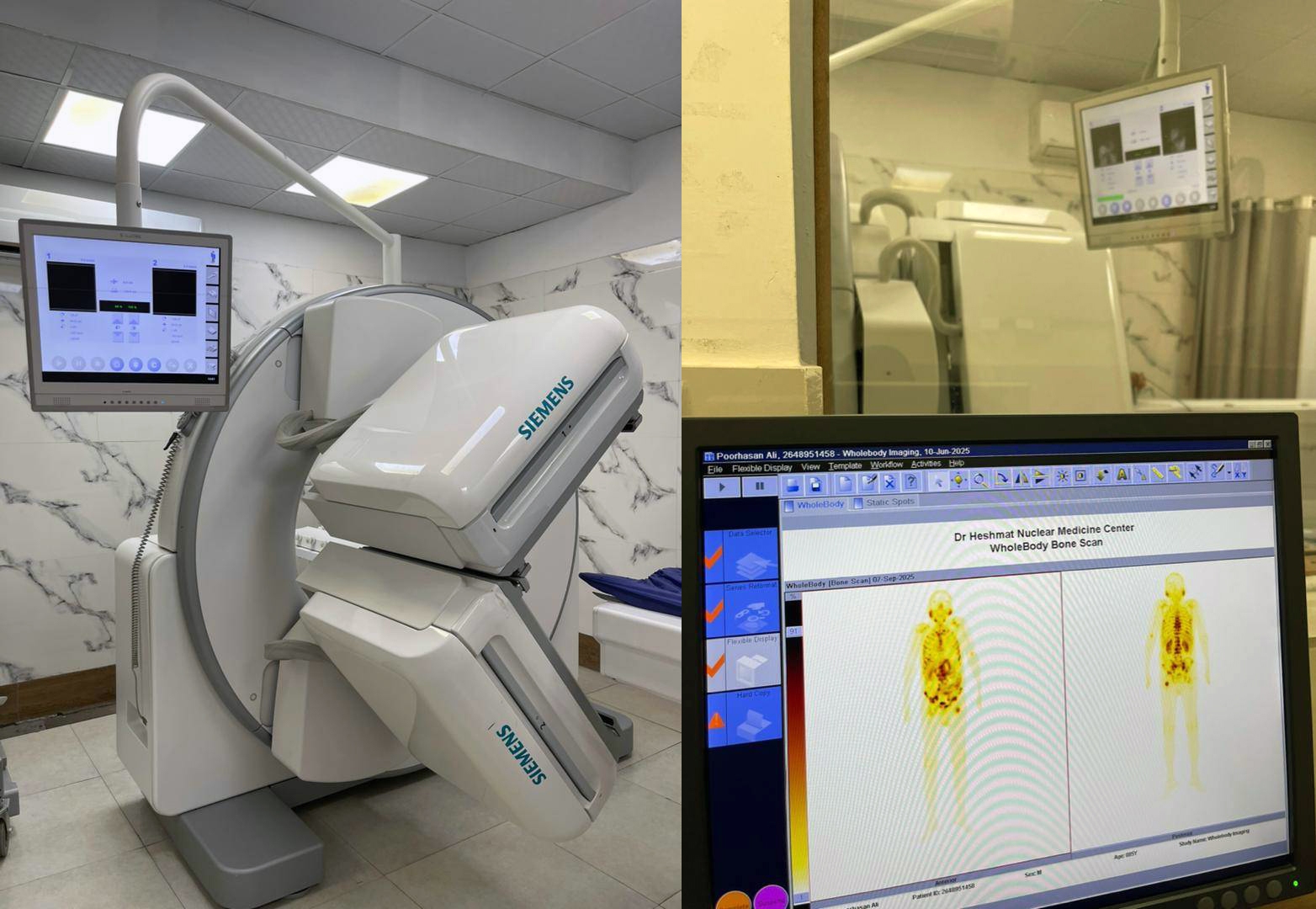 نخستین درمان هدفمند سرطان پروستات پیشرفته با رادیوداروی لوتیشیوم ۱۷۷ در گیلان
