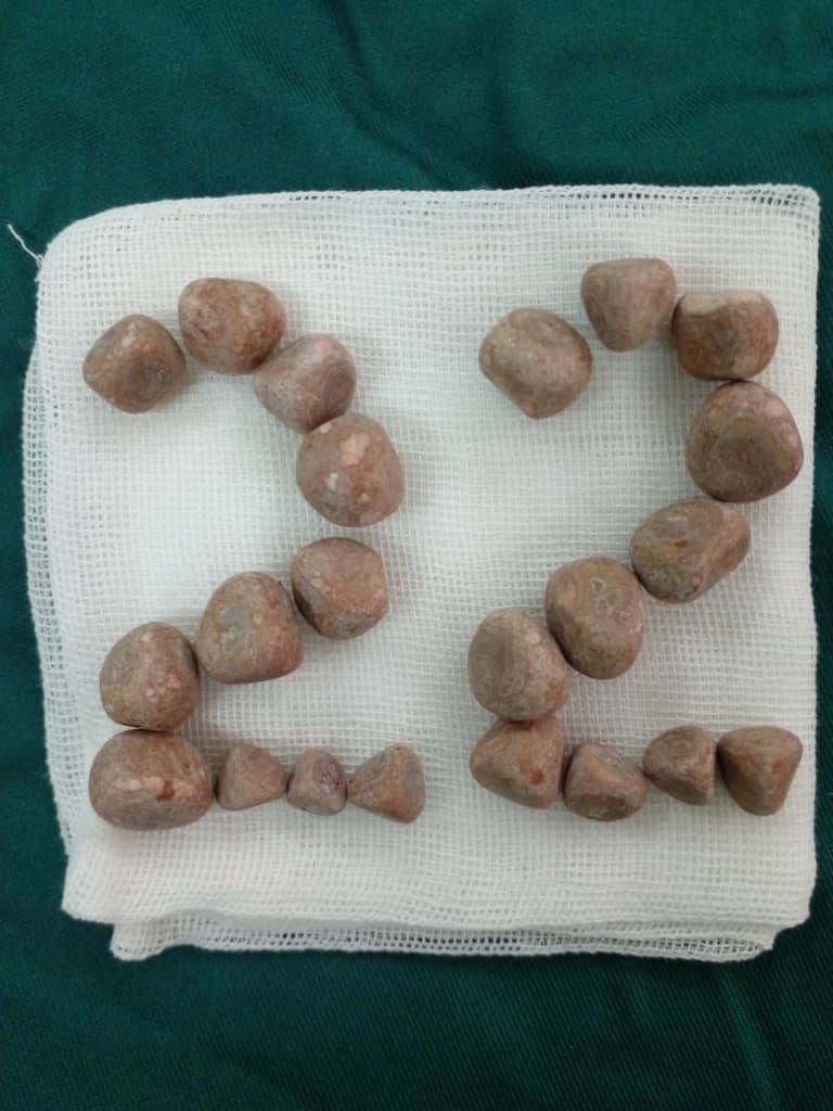 خارج‌سازی ۲۲ سنگ از مثانه بیمار ۹۰ ساله در آباده